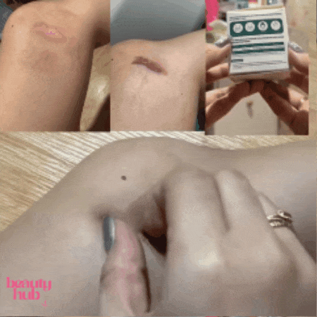 Hojas de Silicona para Cicatrices - Ayuda a MEJORAR, SUAVIZAR y APLANAR su apariencia! OFERTA 2X1